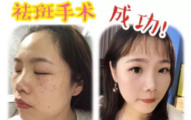 90后全網(wǎng)百萬粉絲母嬰達(dá)人，鷹眼祛斑王全過程分享